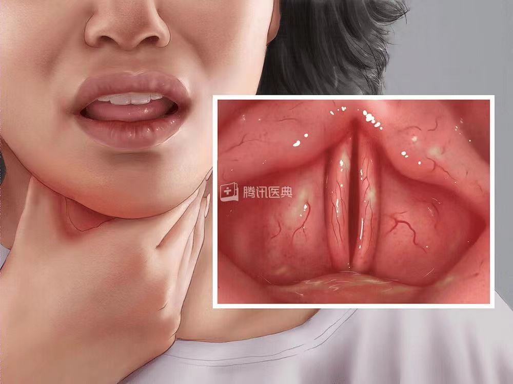 急性喉炎为什么这么危险?这种病可能是要命的!抓紧带孩儿去医院!